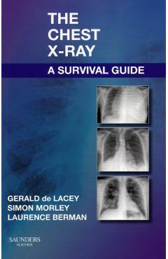 Chest X-Ray: A Survival Guide - Gerald De Lacey