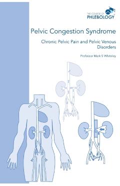 Pelvic Congestion Syndrome - Chronic Pelvic Pain and Pelvic Venous Disorders