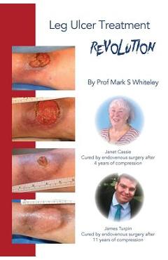 Leg Ulcer Treatment Revolution
