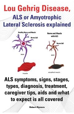Lou Gehrig Disease, ALS or Amyotrophic Lateral Sclerosis Explained. ALS Symptoms, Signs, Stages, Types, Diagnosis, Treatment, Caregiver Tips, AIDS and - Robert Rymore