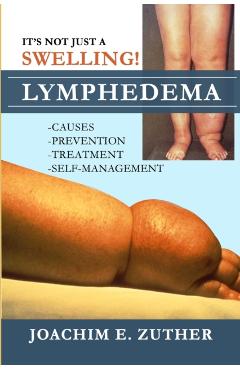 It's Not Just a Swelling! Lymphedema: Causes, Prevention, Treatment, Self-Management - Joachim Zuther